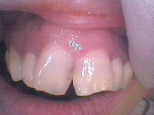 治療前上顎前歯６本