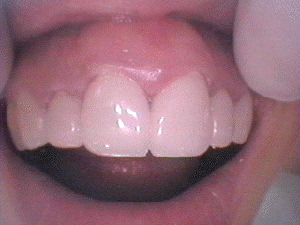陶材焼付鋳造冠にて上顎前歯６本を処置